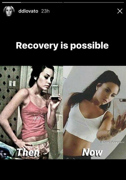 Demi Lovato julkaisee järkyttävän anoreksiansa ennen ja jälkeen